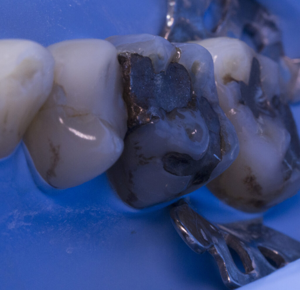 close up amalgam fillings
