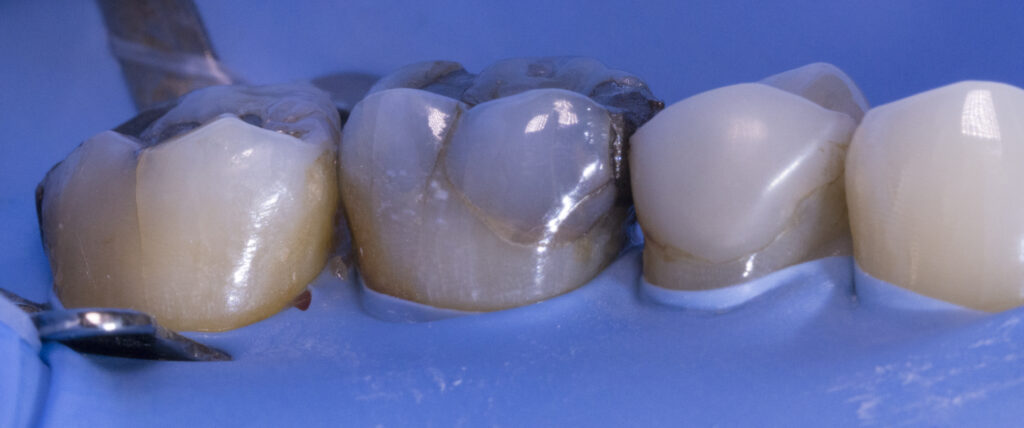 close up amalgam fillings 2