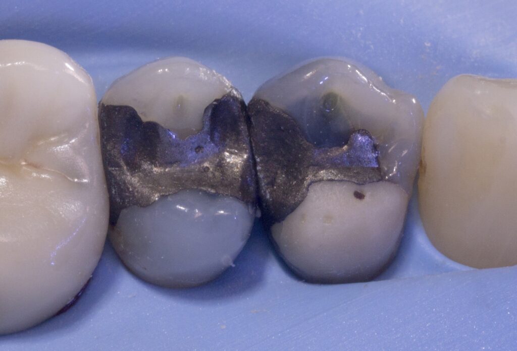 close up of amalgam fillings
