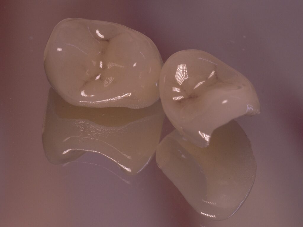 close up of porcelain crowns
