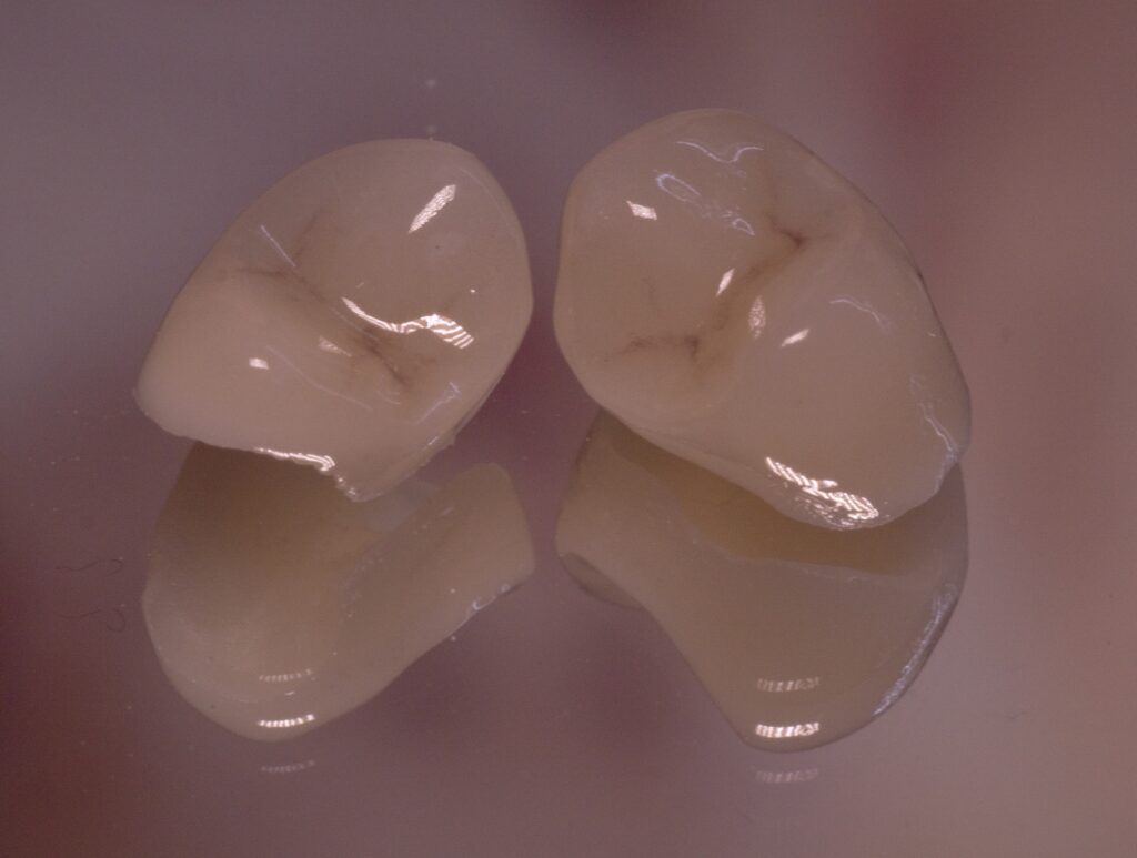close up of porcelain crowns 2