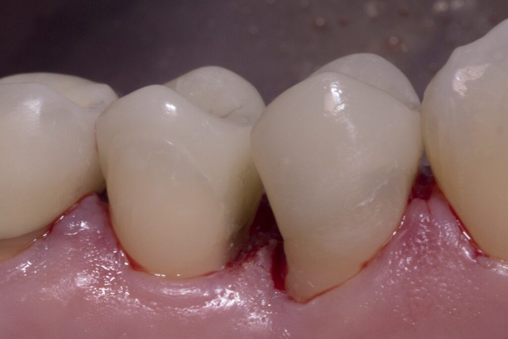 close up pre molars