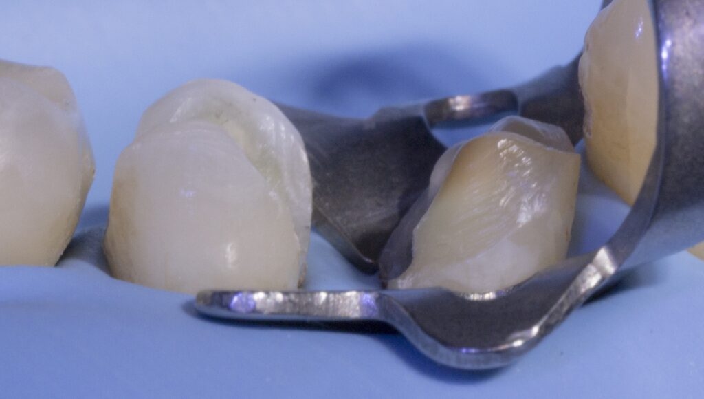 close up tooth with rubber dam